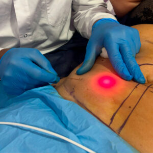 Endolift